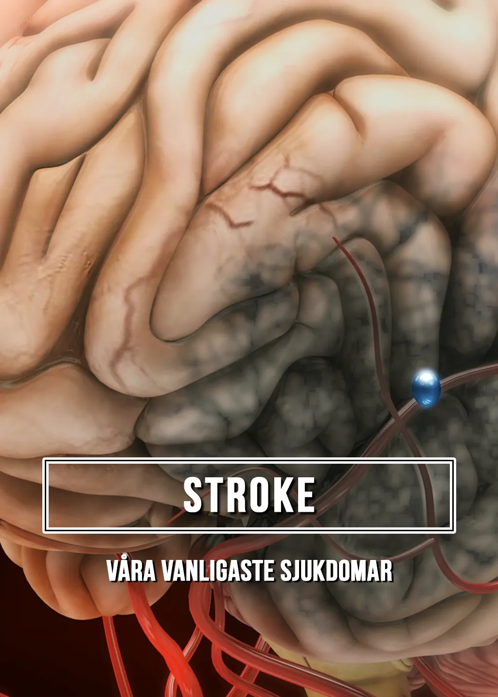 Stroke